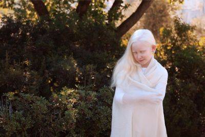 5 необычных фотографий альбиносов: уникальная подборка - clutch.net.ua - Запорожье