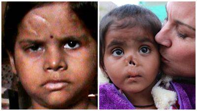 Женщина удочерила двух девочек с особенностями: как они выглядят спустя 7 лет - любовь творит чудеса (ФОТО) - clutch.net.ua - Индия
